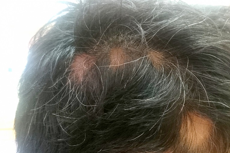 帯状疱疹による頭痛広島 頭痛・脳神経専門医のつぶやき