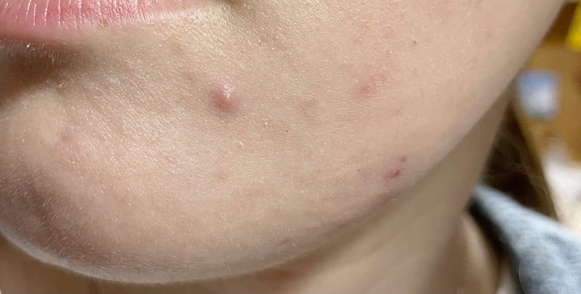 ニキビ跡の赤みを消す治療法レーザー×イソトレチノイン併用 肌のクリニック