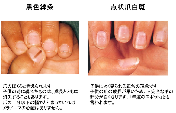 亜鉛不足による「爪の５つの症状」について 白い斑点・横線などひまわり医院 内科・皮膚科