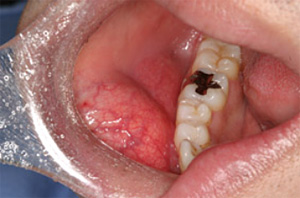 歯茎の良性腫瘍とは？原因や症状、放置リスクや口腔がんとの関連性