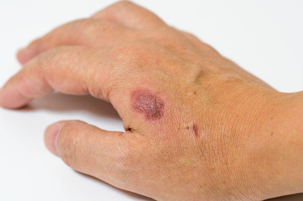 衝撃！ ムカデに噛まれたらどうなる？刺された時の症状と対処方法について皮膚科専門医が詳しく解説 アナフィラキシーショック、破傷風医療法人義恵会公式サイト