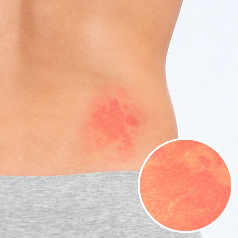 4. アトピー性皮膚炎の症状