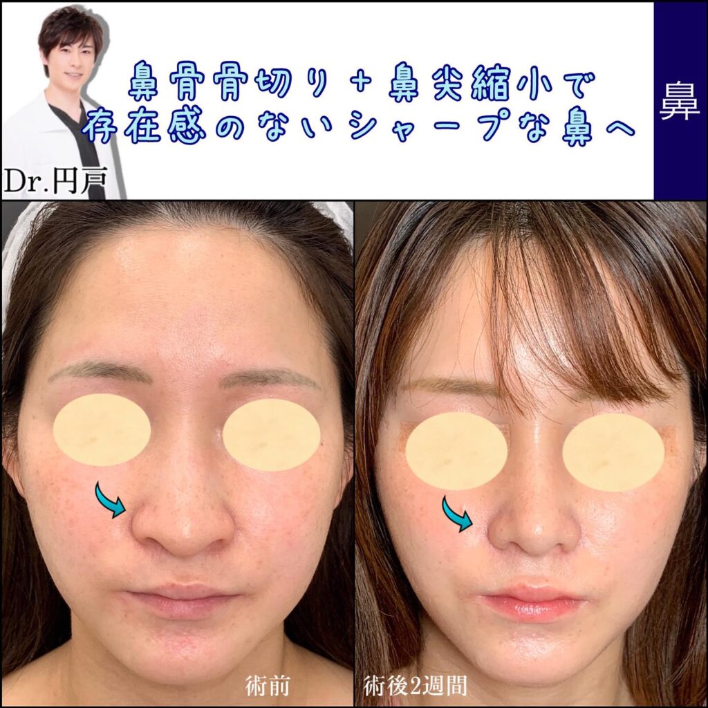 鼻を高くしたい方必見！自力で鼻を高くできる可能性がある方法をご紹介金沢の美容整形・美容外科はeクリニック