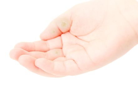 大人も子供もうつる「水いぼ」の症状や治療・日常のケアについてひまわり医院 内科・皮膚科