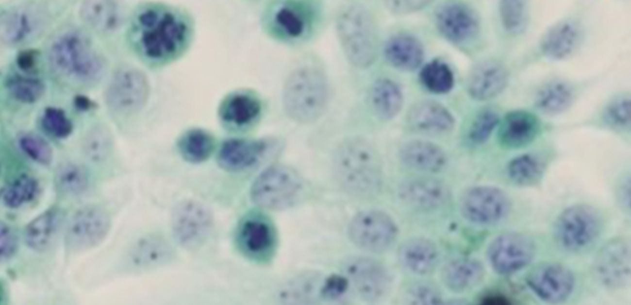 上皮内がんとは？がん保険の対象になる？ 保険市場