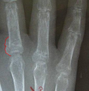 接骨院 志木ほねつぎの技術～指は精密機械のようなもの～