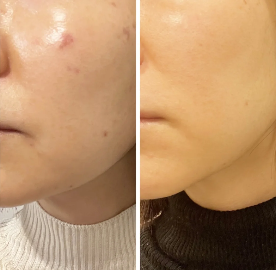 40代でシミがない人の特徴は？40代でシミができやすい原因と違いを美容皮膚科医が解説！恵比寿駅徒歩1分の美容皮膚科ATELIERMedical Clinic アトリエメディカルクリニック