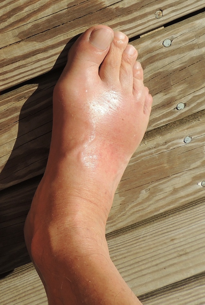 墨田区 本所吾妻橋 さとう内科クリニック 痛風