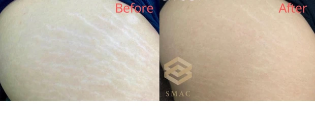 思春期の女子にある「肉割れ」のコウケントー光線治療たんぽぽコウケントー光線治療院