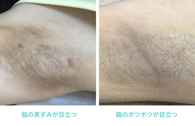 パースピレックスは黒くなる？色素沈着する？原因や対策