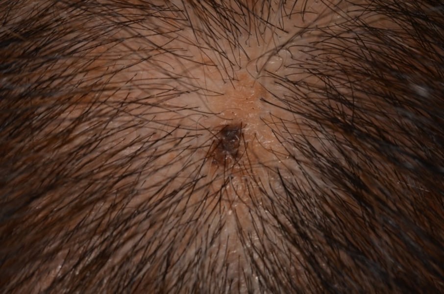 あたまのフケ、それって皮膚の病気かも！あつた皮ふ科・美容皮膚科クリニック名古屋市中川区の皮ふ科・美容皮膚科