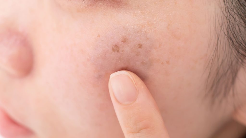 鼻の白いポツポツ - 私は昔から小鼻がいちごで特に左脇の方が Q&A - @cosme アットコスメ