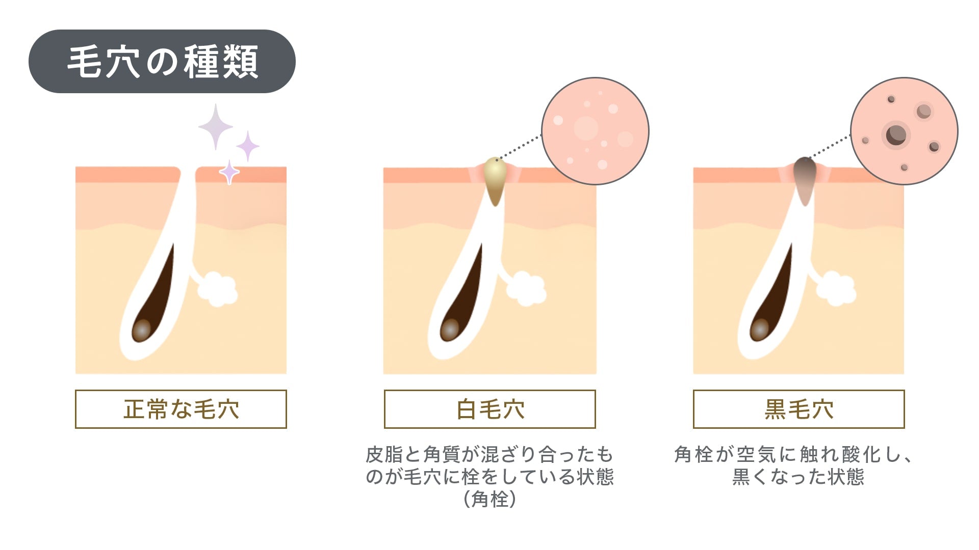 毛穴の黒ずみの原因って？ 絶対にやってはいけないケアと正しいケアを徹底解説！ – favs