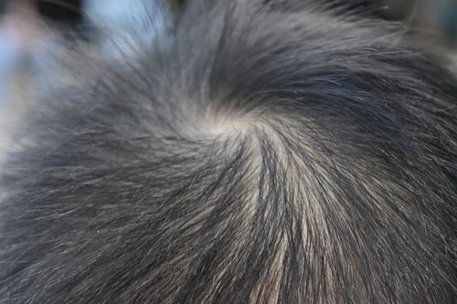 10代の若はげの原因は？中学生や高校生におすすめの薄毛対策について解説