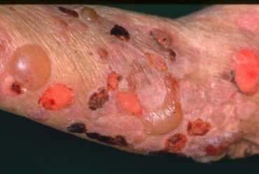 類天疱瘡：自己免疫性水疱症