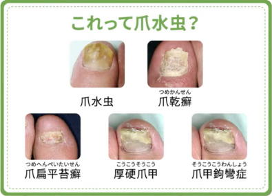 糖尿病の初期症状は爪に現れる？見逃せないサインと早期対処法 - グッドライフクリニック西町南