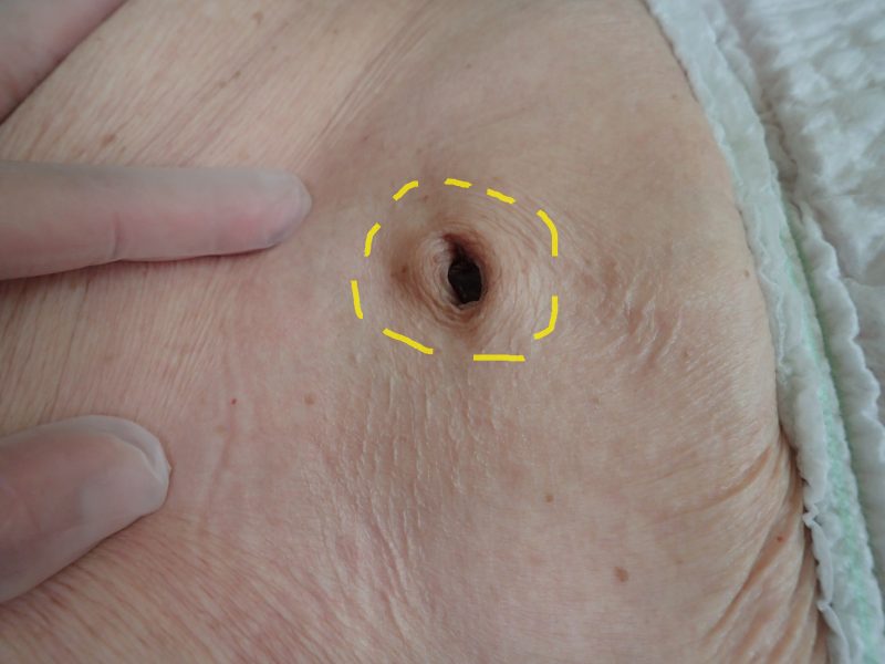 子どものおへその中が赤い「臍炎」の対処。病院は何科？臭い・膿み医師監修kosodate LIFE 子育てライフ