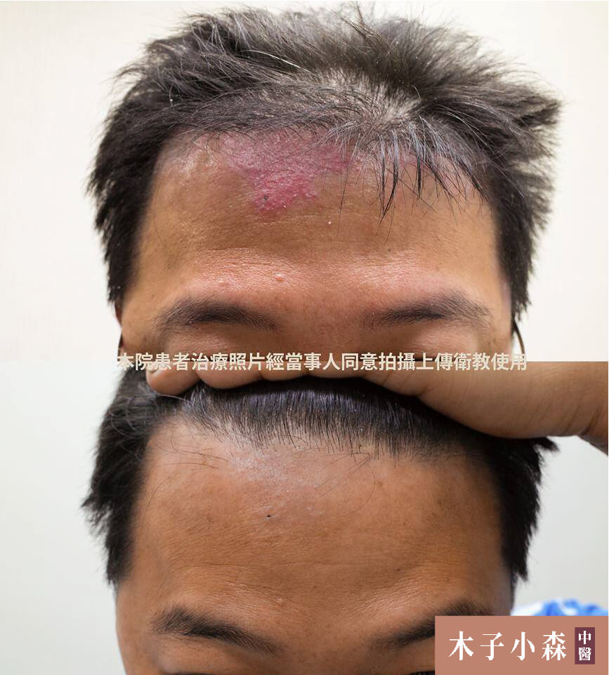 牛皮癬 乾癬 是什麼？該如何治療？-20skin美醫集團-「二林皮膚科 四季診所」