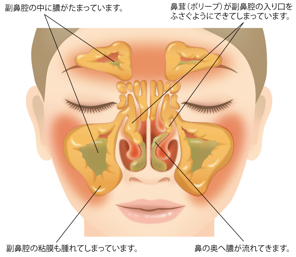 鼻の下 人中 の粉瘤症例 56歳男性 Y様あすなろクリニック