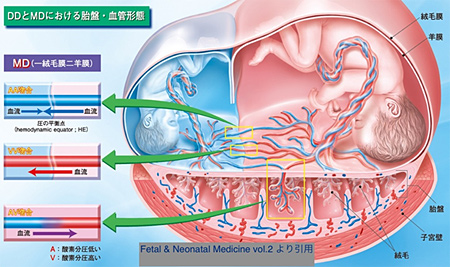 膜性診断でわかる双子妊娠のリスクとは