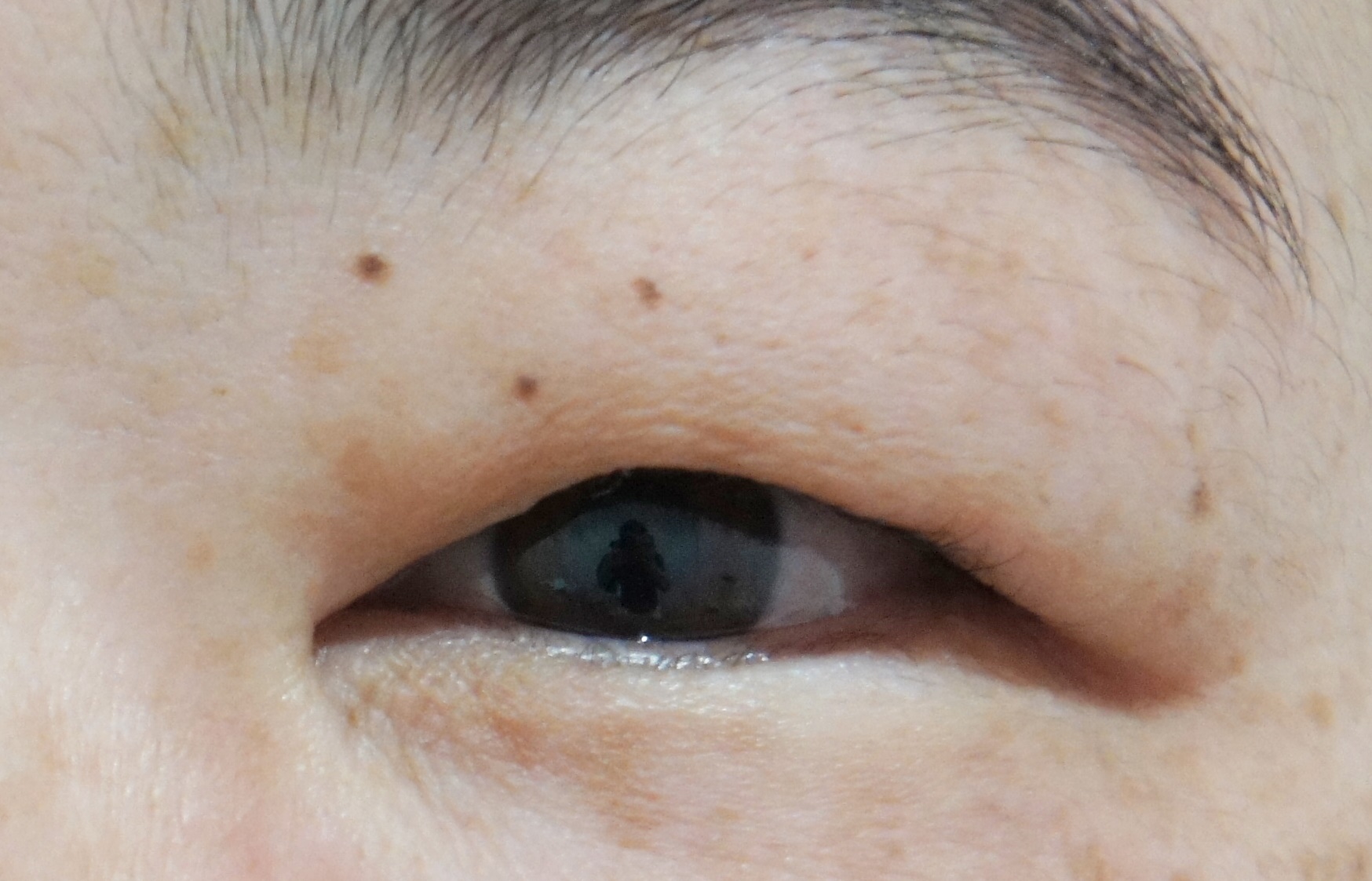 上まぶたの脂肪取り品川美容外科 公式