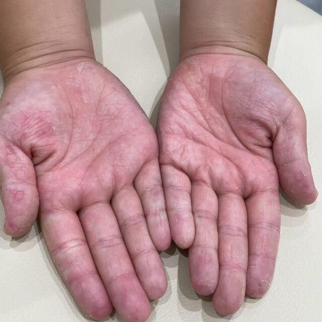 一歳になる子です。 - 片足だけ足の指の皮が剥けて、点々と赤い内出血- Yahoo!知恵袋