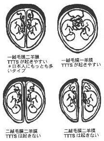 双子の膜性による分類 カラーイラスト - No: 22743075無料イラスト・フリー素材なら「イラストAC」