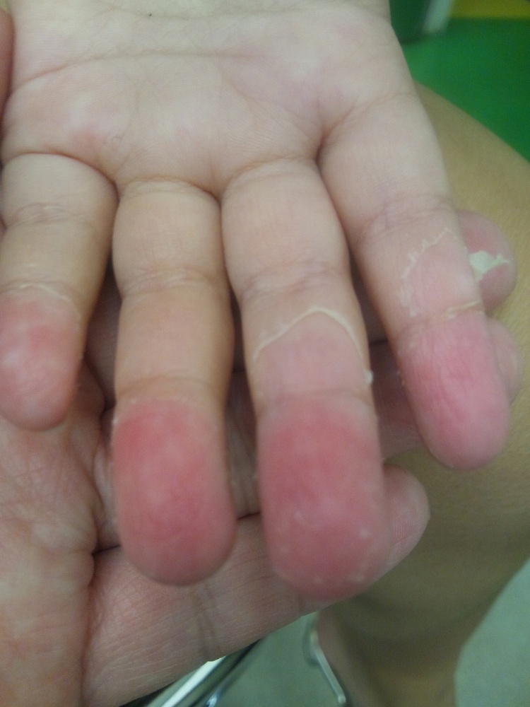 皮膚の悪性腫瘍 皮膚がん品川区 あおよこ皮膚科クリニック