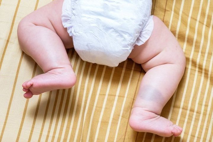 青あざができやすいのはなぜ？ぶつけていないのにできる原因や子どもの生まれつきの青あざも紹介