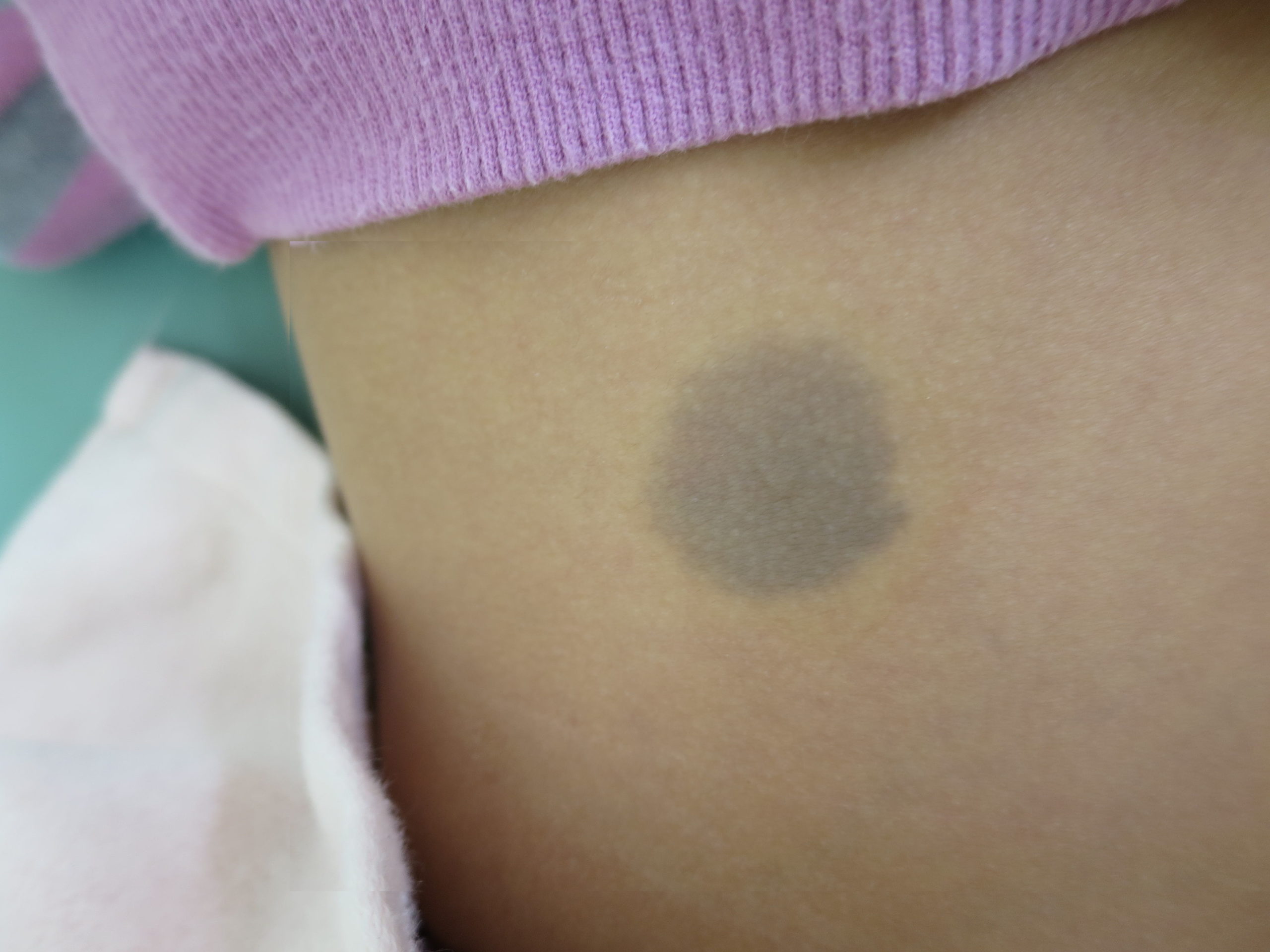 蒙古斑の原因は？赤ちゃんのおしりの青あざの正体！赤ちゃん・子供のあざ治療なら最新レーザー治療×形成外科専門医の大阪梅田形成クリニック