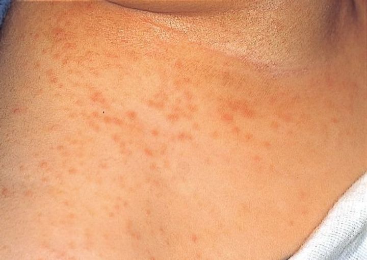 あせも - 茨木市の小児科－はら小児科クリニック