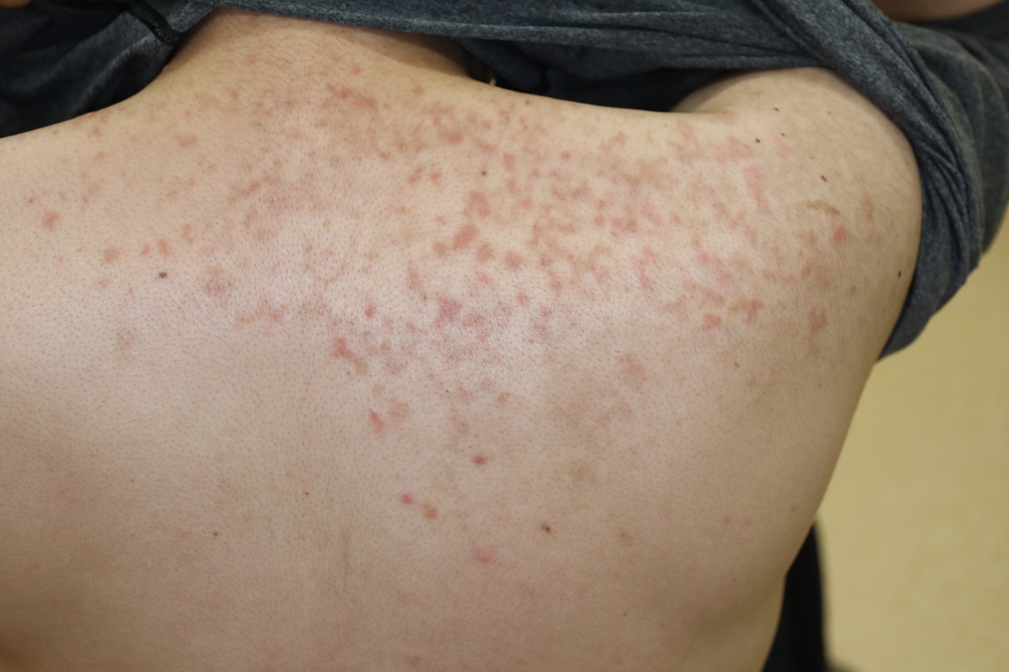 アトピー性皮膚炎原因・症状・治療法大正健康ナビ大正製薬