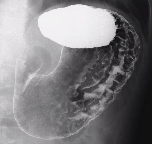 バリウム検査 消化管X線造影検査 について 前編