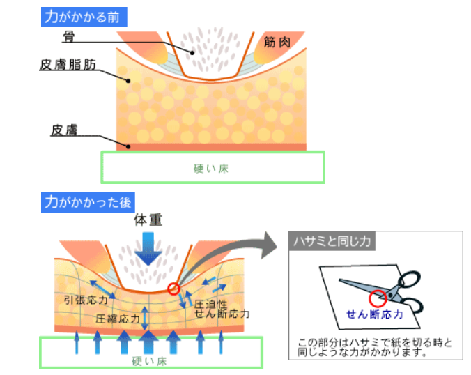 褥瘡の発生要因・メカニズムをおさらいしよう!ナース専科 - Part 1000