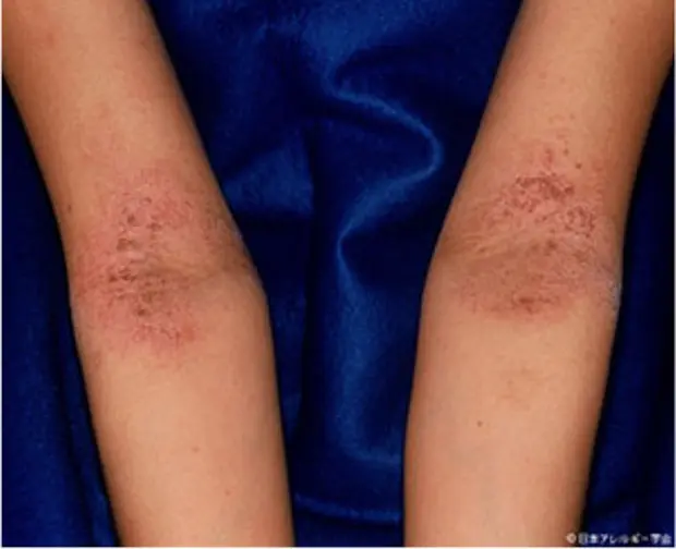 虫刺され ダニに刺された！症状や対処法のポイントは？－ダイコクライフスタイル