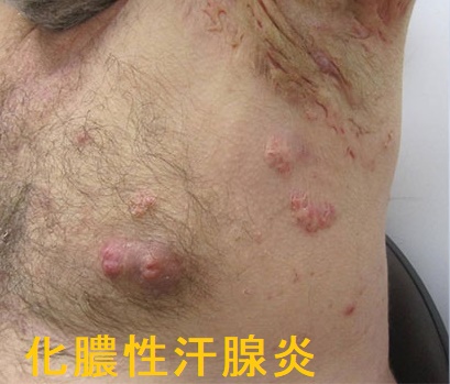 炎症後色素沈着の治療を皮膚科専門医が症例写真で解説うらた皮膚科