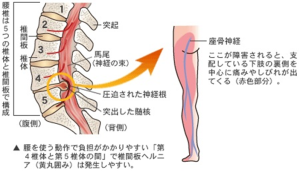 脊柱管狭窄症の手術後3年で坐骨神経痛が再発してしまわれた70代男性治療症例