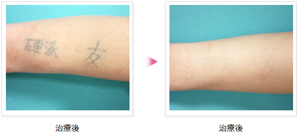 タトゥー除去ピコレーザー , レーザー機器「ディスカバリーピコプラス」を使用して、,タトゥーを除去する施術です。, レーザーを当てることで、, 色素を少しずつ薄くしていきます。, 3つの波長を組み合わせて照射するので、,黒だけでなくカラーのタトゥーも除去可能です。, 照射時間が短く、タトゥーの部分以外の, 肌への負担を抑えられます。,