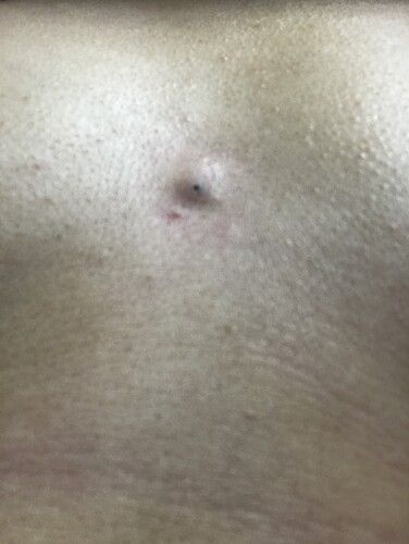 胸の粉瘤 －小さな傷ー - SSクリニック - 皮膚科・美容外科 - 名古屋市中区