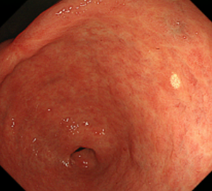 空腹時の胃の痛みは「胃酸過多」の特徴的な症状です。 ワクナガ胃腸薬Uは、胃酸の分泌抑制と胃粘膜の保護成分をバランスよく配合した胃腸薬です。湧永製薬ワクナガワクナガ胃腸薬U胃腸胃腸胃もたれ胸やけ飲み過ぎ食べ過ぎ胃痛消化不良空腹時の