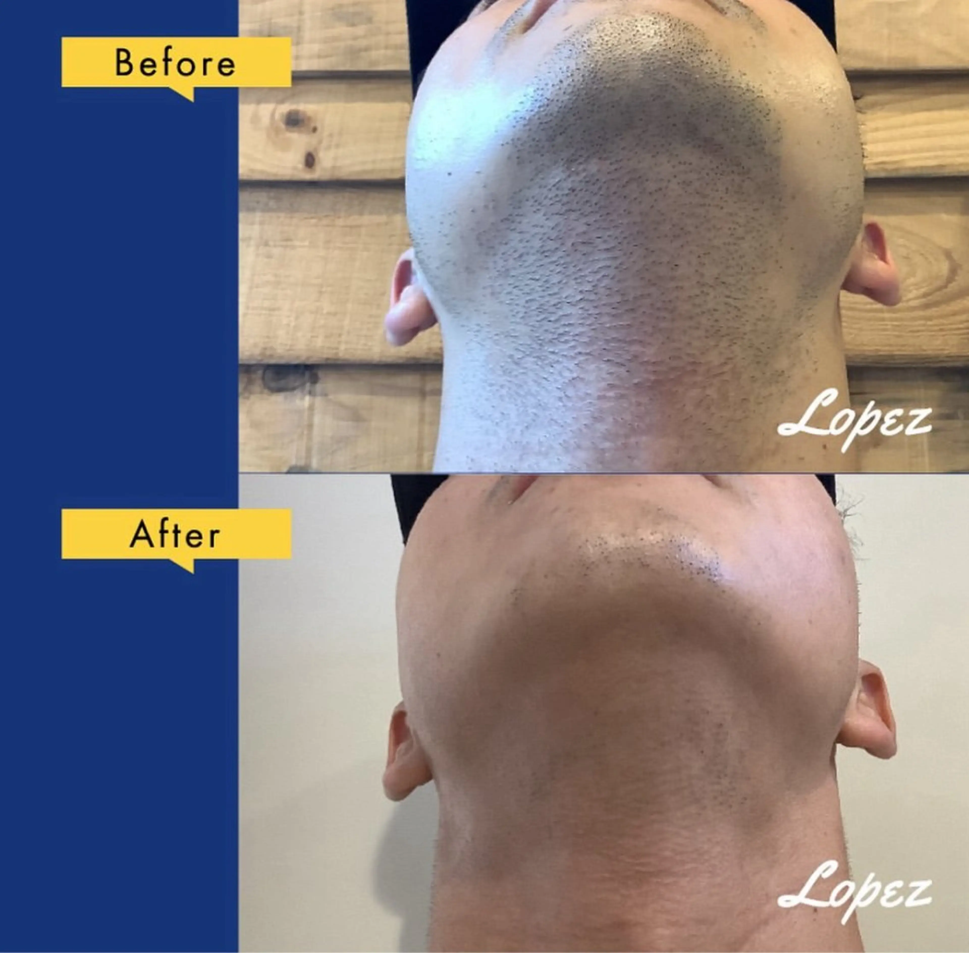 医療脱毛とエステ脱毛の違い を医師が比較して紹介！どっちが良い？グランツクリニック