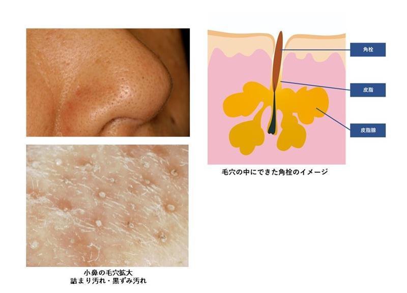 角栓 アーカイブ -公式 ルナビューティークリニック美容皮膚科・美容外科・医療脱毛