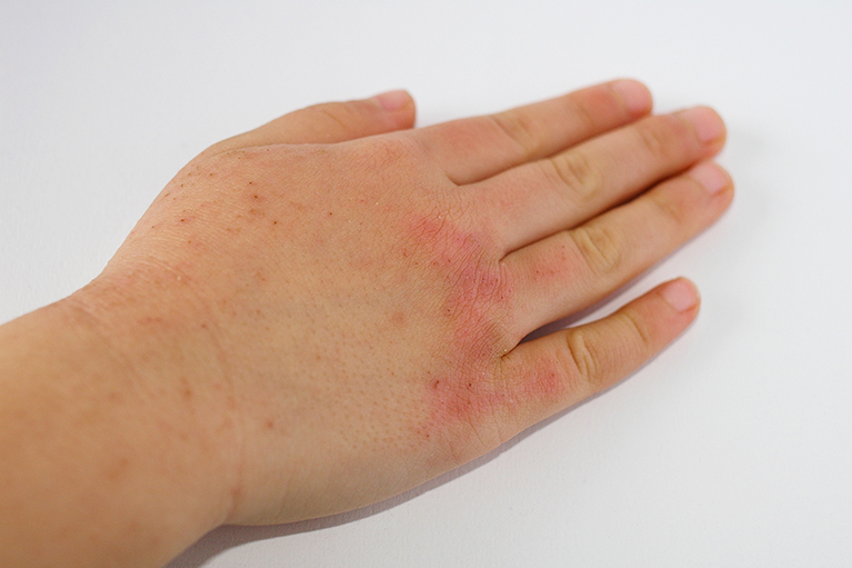 ストレスで湿疹」ができる原因をご存知ですか？医師が徹底解説！ - ライブドアニュース