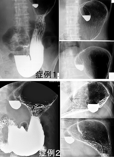 胃カメラで診断できる病気紹介西宮で『胃カメラ』なら ほその内科 おなかクリニック