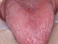 真菌”によって引き起こされる口腔感染症、『口腔カンジダ症』とは？新橋歯科医科診療所 痛くない削らない歯医者