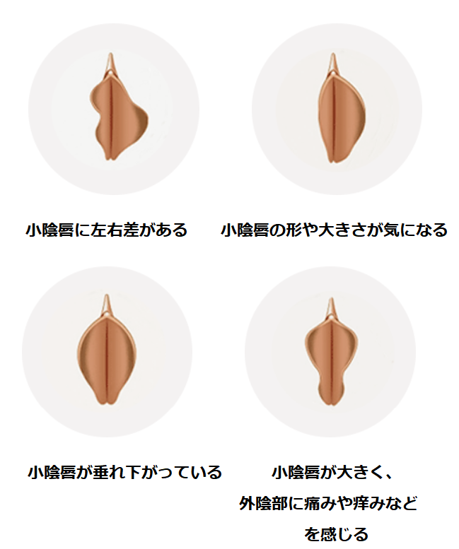 カンジダ膣外陰炎