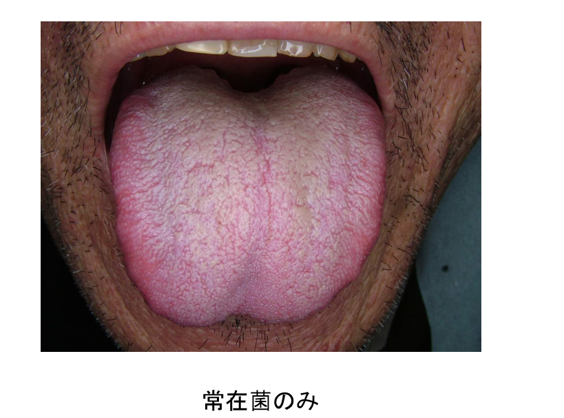 口腔カンジダ症