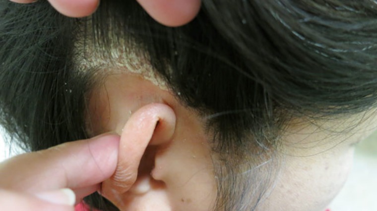 男頭皮如龜殼是乾癬惹得禍- 健康- 中時