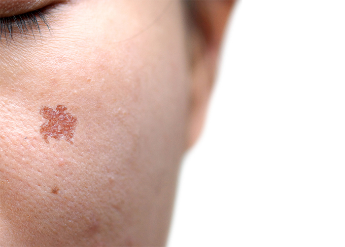 40代後半で「シミ取り放題」を決断！無数にあったシミとそばかす肌のビフォーアフターミモレ編集部のリレー連載 今日のお助けコスメmi-mollet ミモレ明日の私へ、小さな一歩！ 1 2