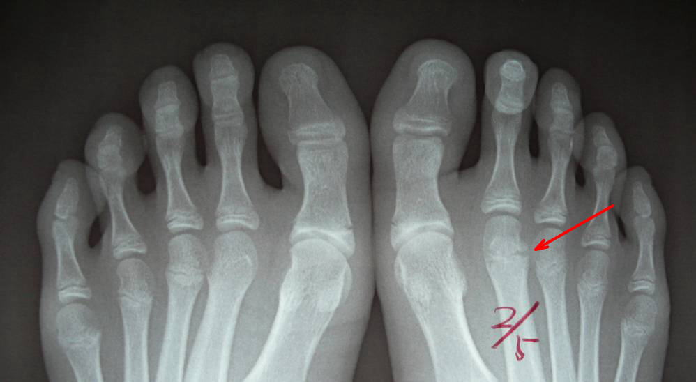 骨端線損傷は子供特有の成長軟骨のケガ – 小金井市の とも整骨院